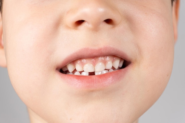 Loss of milk teeth in children A sixyearold child shows the first baby tooth that has fallen out