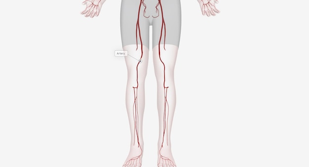 Foto gli interventi arteriosi degli arti inferiori sono procedure progettate per ripristinare il flusso sanguigno alle gambe e ai piedi