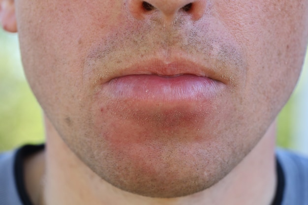 Photo the lower lip was swollen. the face swelled after the bee sting