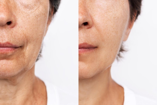 Photo lower part of elderly woman's face and neck with signs of skin aging before after facelift, surgery