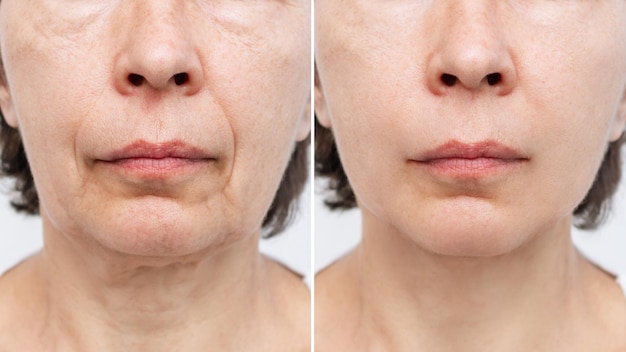 Photo the lower part of face and neck of elderly woman with signs of skin aging before after facelift