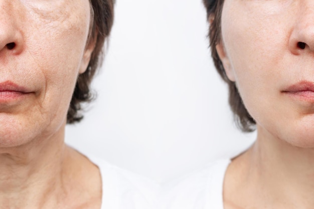 Lower part of a face and neck of elderly woman with signs of skin aging before after facelift