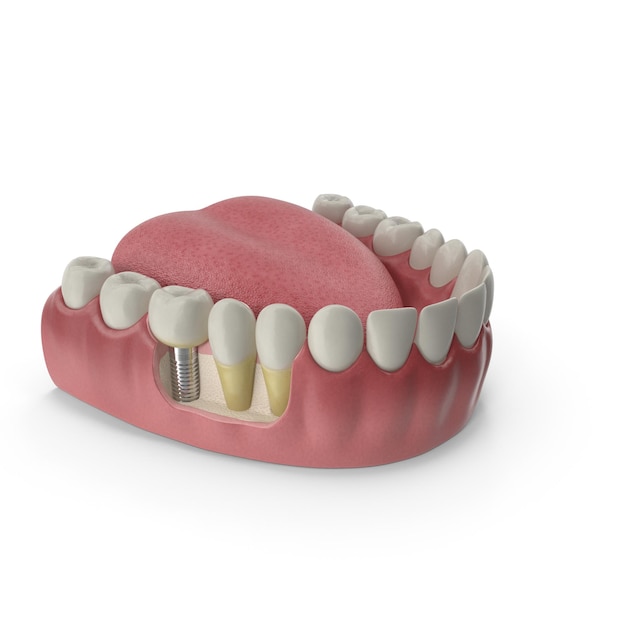 Photo lower teeth medical model with dental implant jaw with abnormal teeth position orthodontic