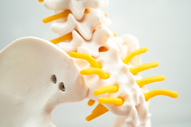 Photo lumbar spine displaced herniated disc fragment spinal nerve and bone model for treatment medical in the orthopedic department