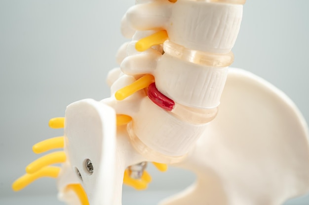 Lumbar spine displaced herniated disc fragment spinal nerve and bone Model for treatment medical in the orthopedic department