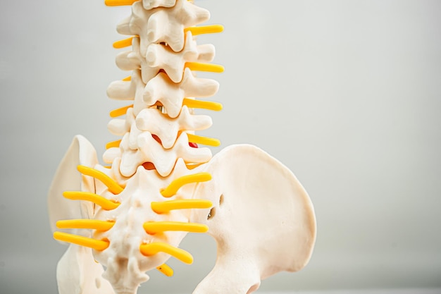 Lumbar spine displaced herniated disc fragment spinal nerve and bone Model for treatment medical in the orthopedic department