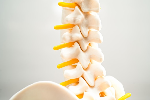 Lumbar spine displaced herniated disc fragment spinal nerve and bone Model for treatment medical in the orthopedic department