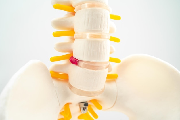 Lumbar spine displaced herniated disc fragment spinal nerve and bone Model for treatment medical in the orthopedic department