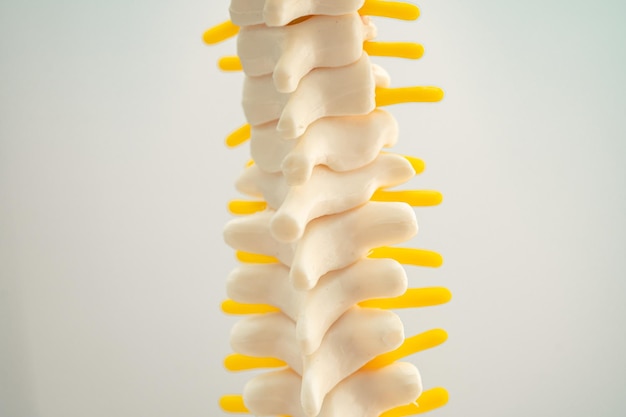 Foto frammento del disco erniato spostato della colonna lombare nervo spinale e osso modello per il trattamento medico nel reparto ortopedico