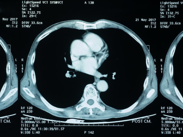 lung cancer from patient who love smoking cigarette 