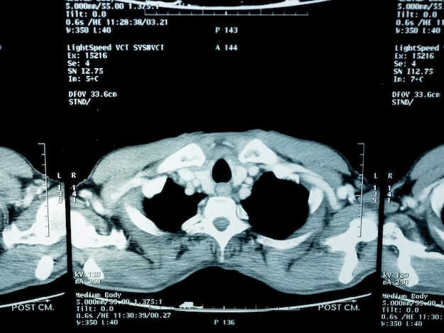 Foto cancro ai polmoni dal paziente che ama fumare sigarette