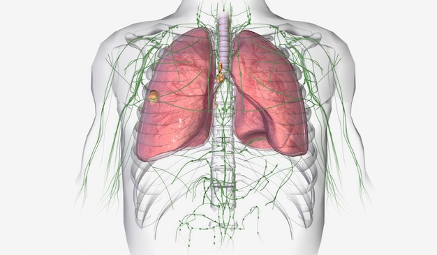 The Lung Cancer Stage II