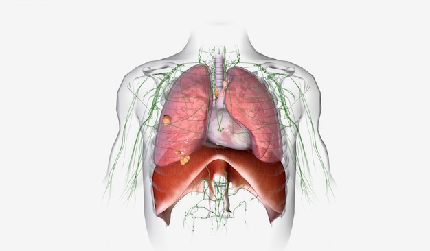 Photo the lung cancer stage iii