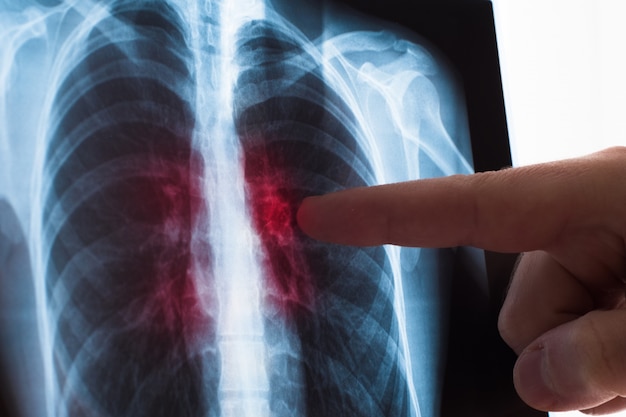 Lung radiography concept. Radiology doctor examining at chest x ray film of patient Lung Cancer or Pneumonia.