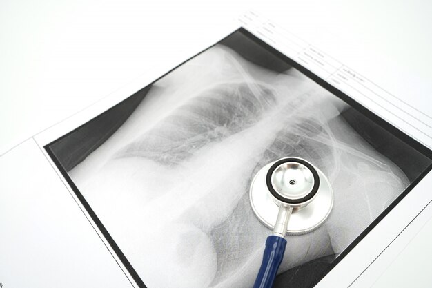 Lung x-ray