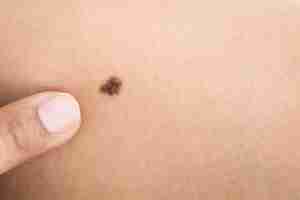 Photo macro black birthmark on skin