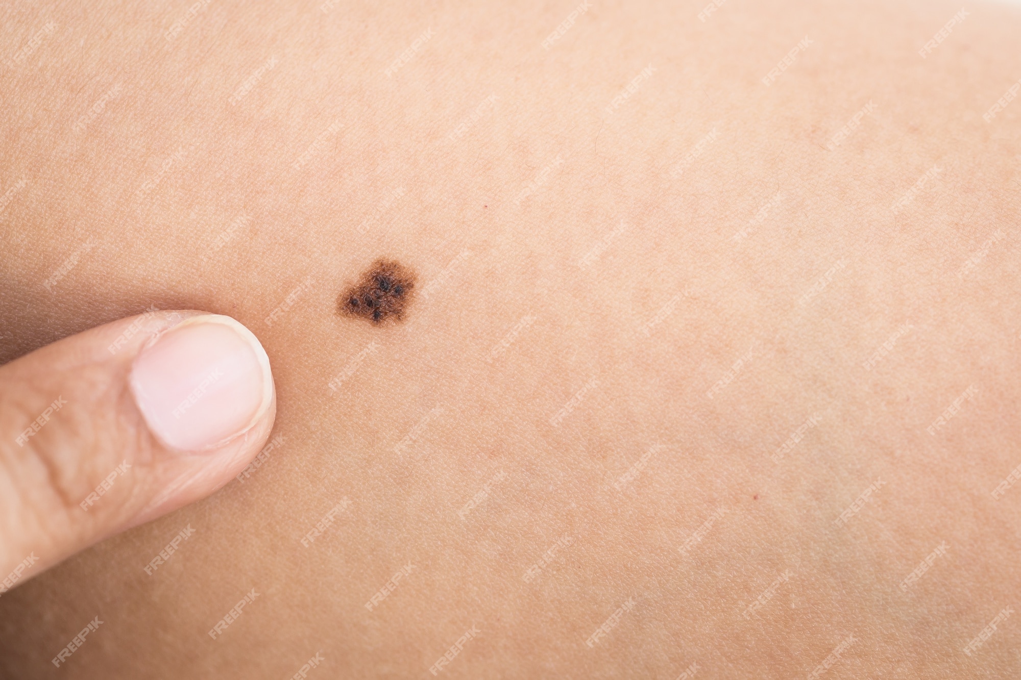 Premium Photo | Macro black birthmark on skin