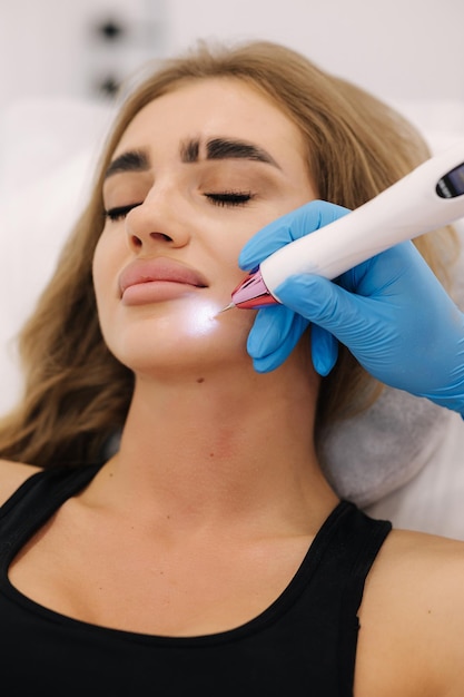 Macro close up detail of laser plasma pen removing facial wart on young woman noninvasive cosmetic