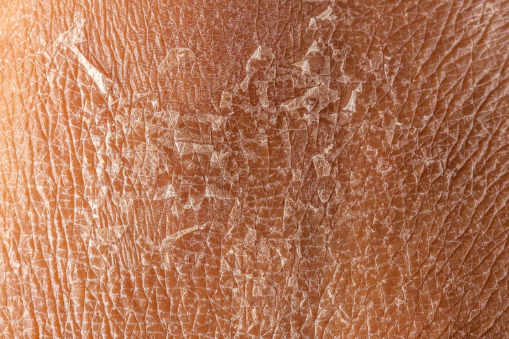 Photo macro of dry peeling skin