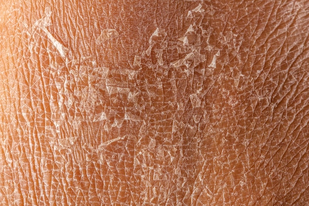 Фото Макрос сухой шелушащейся кожи