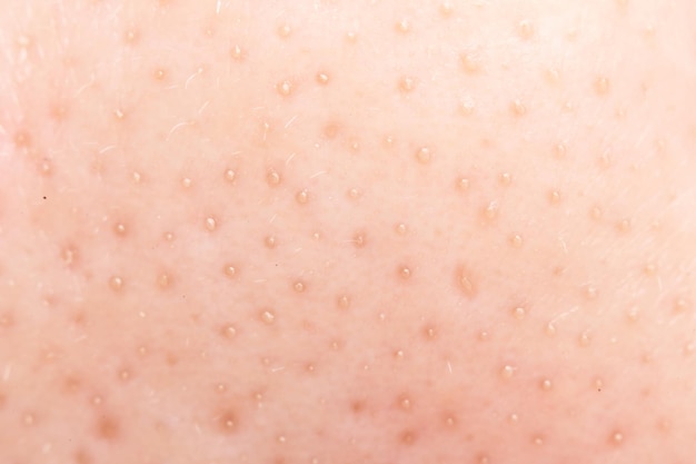 Macro shot of blackheads on facial skin clogged pores