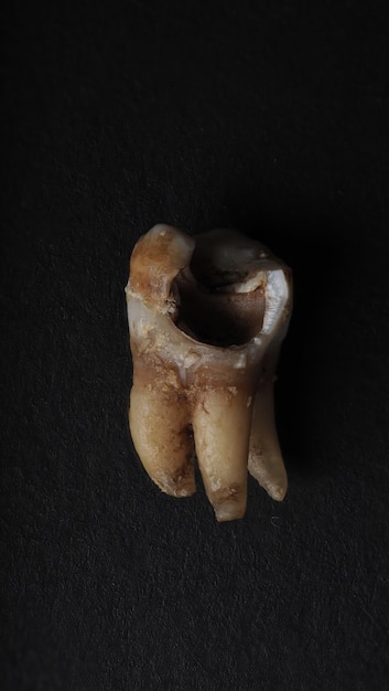 Macro shot of a decayed teeth till root after extraction of dentist