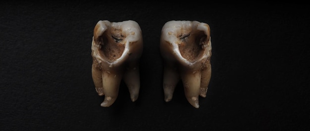 Macro shot of a decayed teeth till root after extraction of dentist