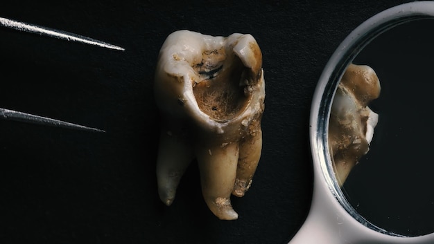 歯科医の抜歯後、根まで虫歯のマクロ撮影