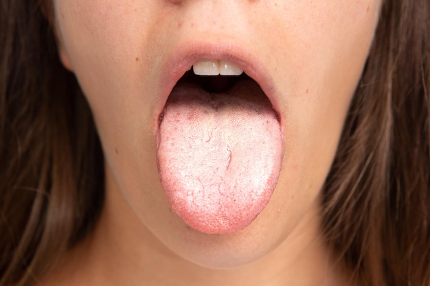 Photo macro of tongue with bacterial patina