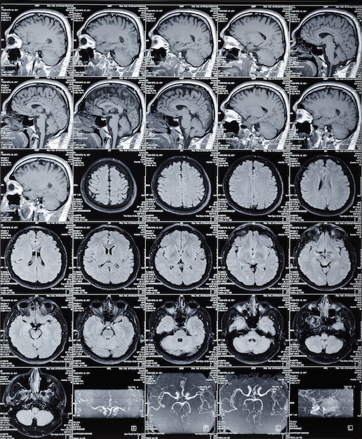 Magnetic resonance brain tomograma