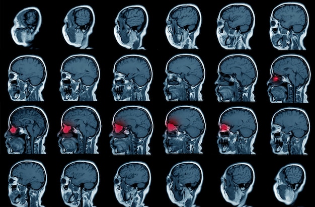 종양의 자기공명영상(mri), 시상면입니다. 56세 남성입니다. 의료 및 의료 개념입니다.