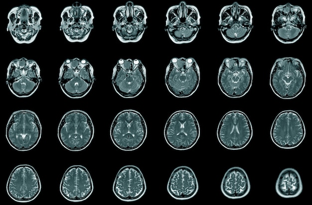 종양의 자기공명영상(MRI), 횡단면 보기. 56세 남성입니다. 건강 관리 및 의료 개념입니다.