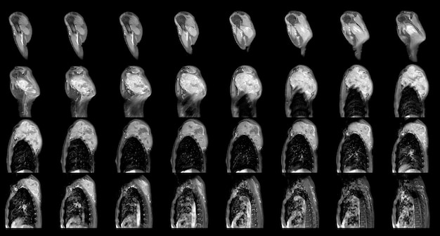 어깨 종양 또는 대량 과학 및 교육 MRI 어깨 배경의 자기 공명 영상