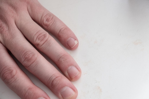 写真 小指の爪が折れた男性の手
