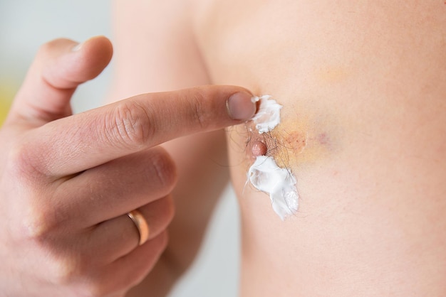 Male nipple injured bruise and hematoma closeup disease health