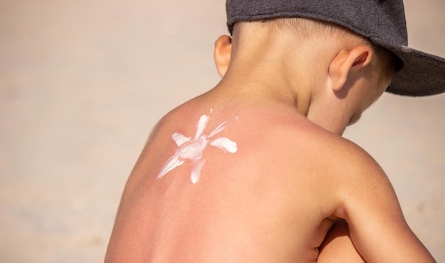 Mam smeert zonnebrandcrème op haar blauwe rug