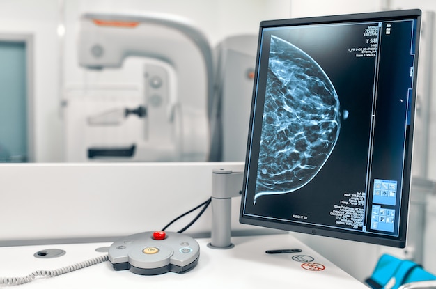 Photo mammogram snapshot of breasts of a female patient on the monitor