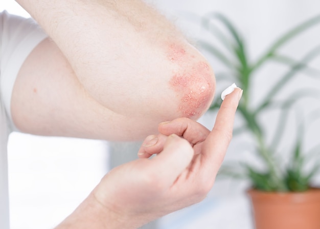 A man applies a cream to the elbow affected by psoriasis