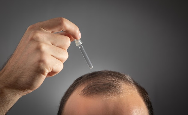 Man applying dropper vitamin on head Baldness treatment concept