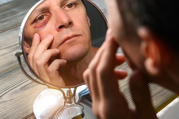 A man examines a large bruise under his eye in the mirror