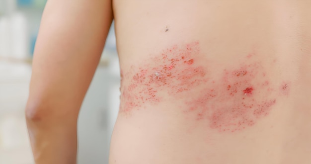 Man has shingles disease