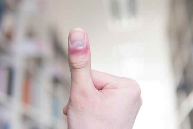 Man heeft pijn in vinger en hand