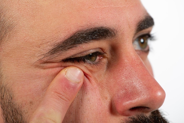 Man holding wrinkles under eyes