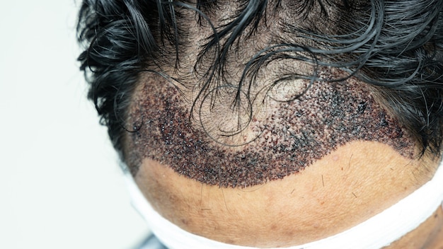 Man hoofd met haartransplantatie chirurgie