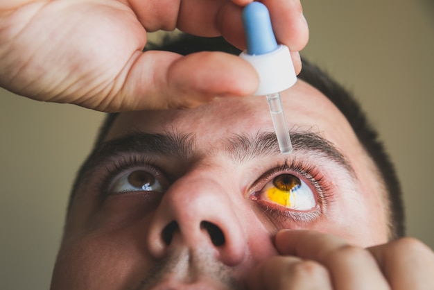 Man is putting drops in his eyes. Medical treatment concept. Allergic conjunctivitis problem.