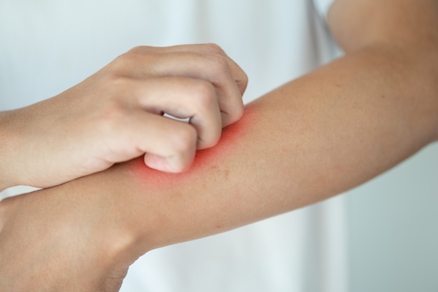 Man itching and scratching on arm from itchy dry skin eczema dermatitis