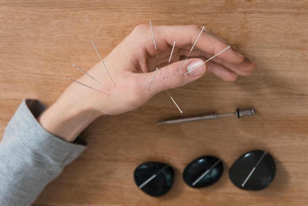 Man met acupunctuur behandeling voor pijnbestrijding