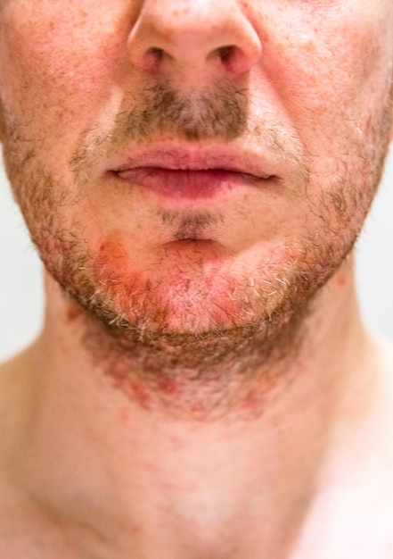 Man met seborrheic dermatitis in het baardgebied