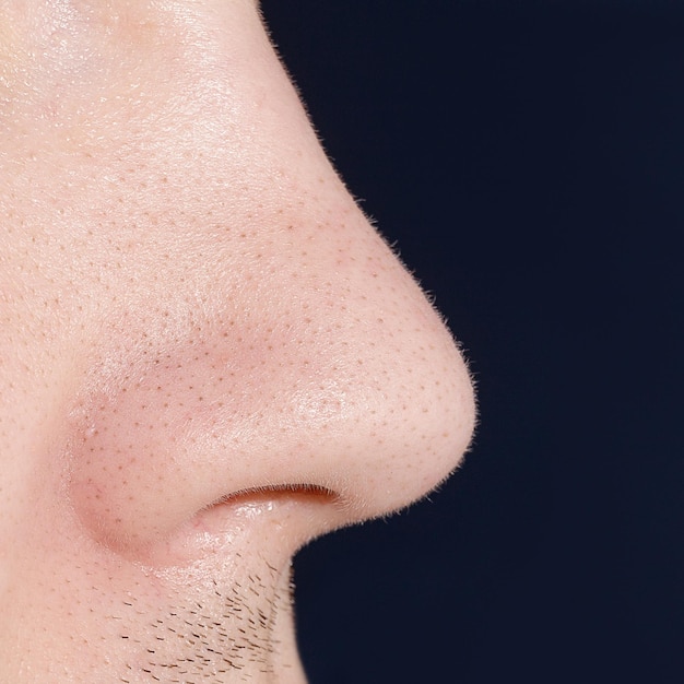 Мужской нос с угрями или черными точками, проблемы с акне, комедоны, расширенные поры на лице