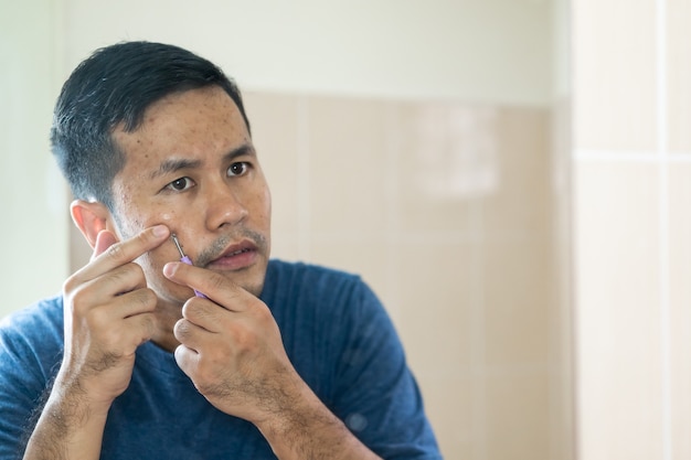 Man pointing acne inflamed occur on his face.